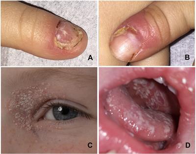 Retrospective identification of the first cord blood–transplanted severe aplastic anemia in a STAT1-associated chronic mucocutaneous candidiasis family: case report, review of literature and pathophysiologic background